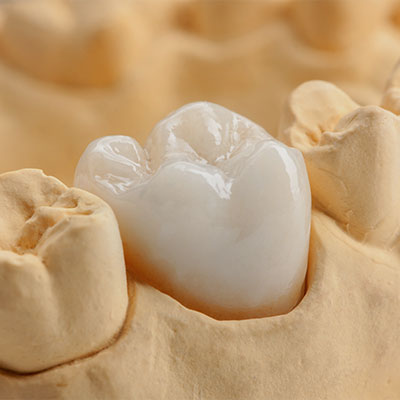 TRANSPLANT 歯の移植