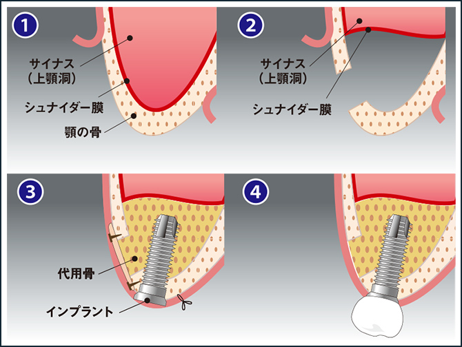 サイナスリフト(ラテラルアプローチ)