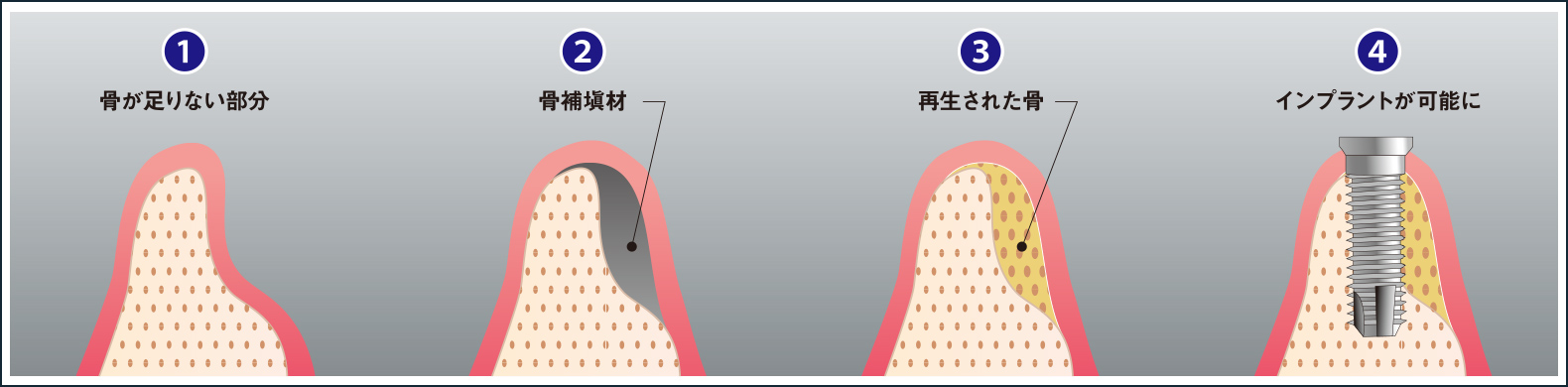 GBR(骨再生誘導法)