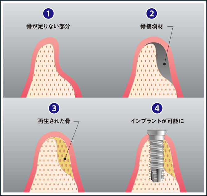 GBR(骨再生誘導法)