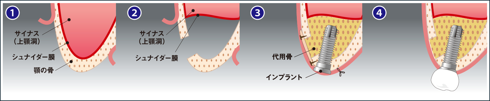 サイナスリフト(ラテラルアプローチ)