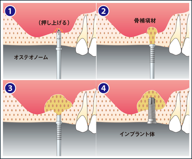 ソケットリフト(クレスタルアプローチ)