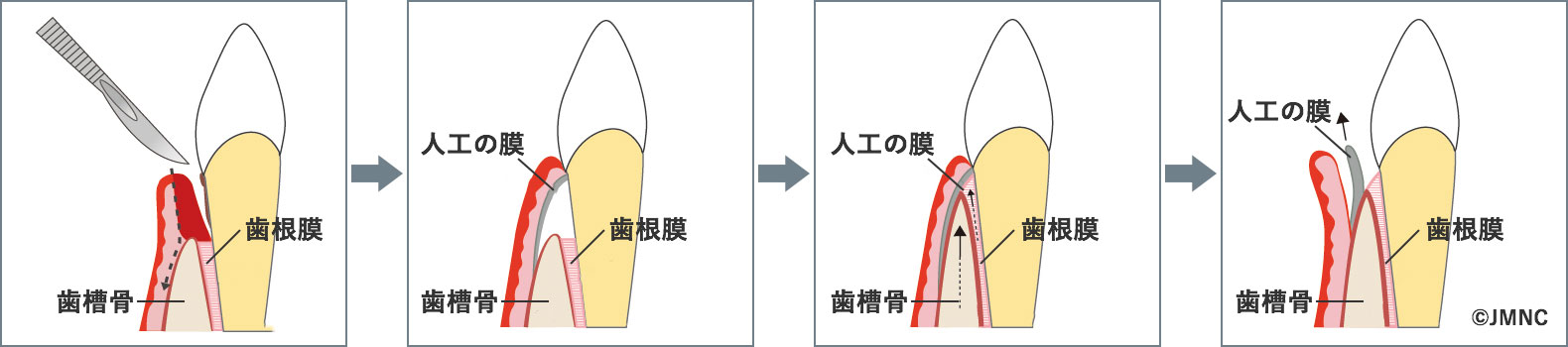 GTR法