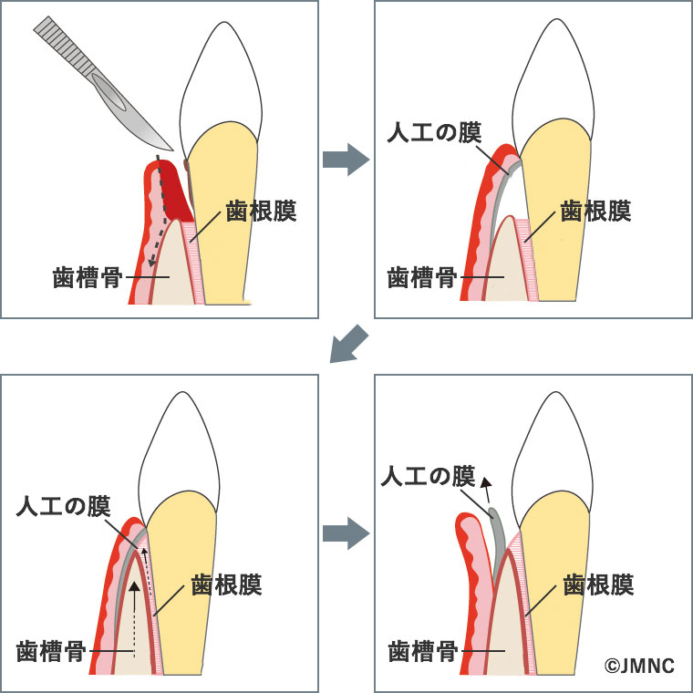 GTR法