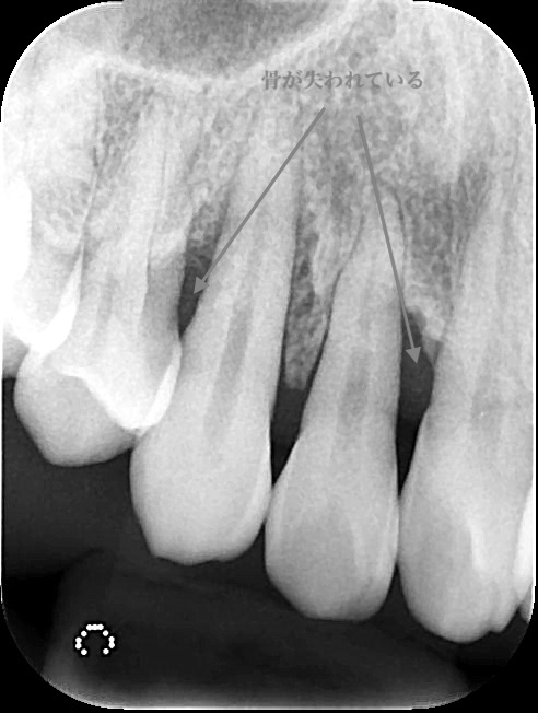 成功率を高めるラバーダム防湿