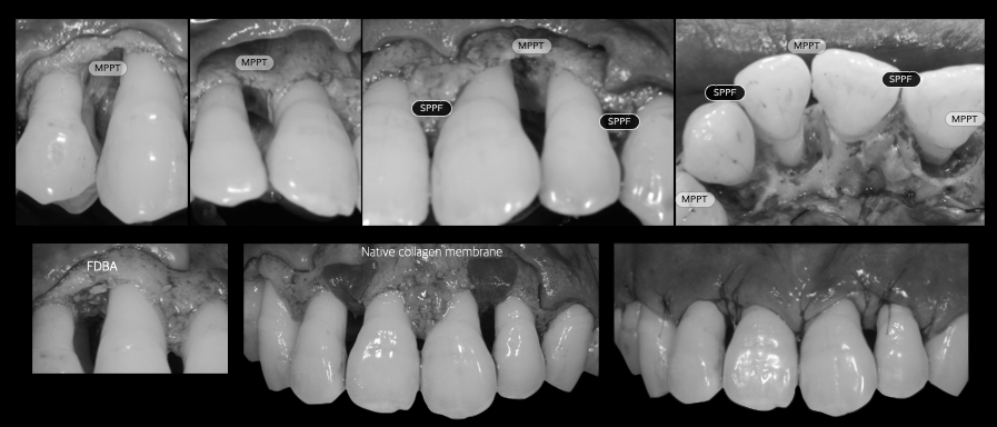 サイナスリフト(ラテラルアプローチ)