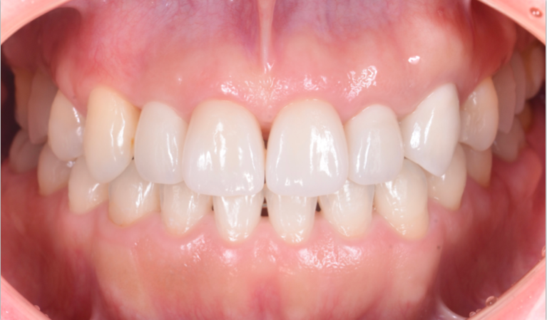 サイナスリフト(ラテラルアプローチ)