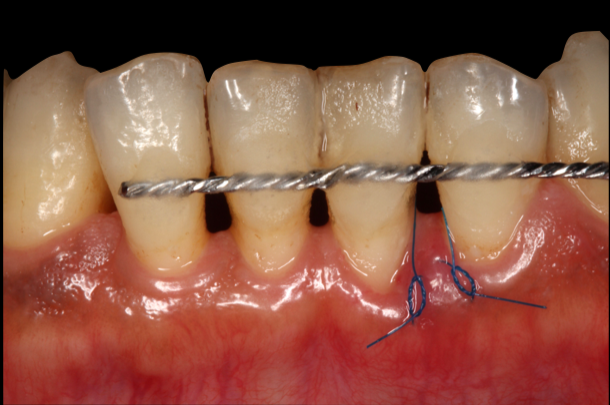 成功率を高めるラバーダム防湿
