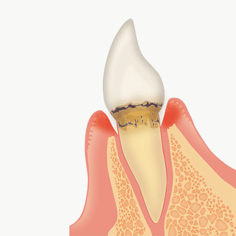 軽度歯周炎