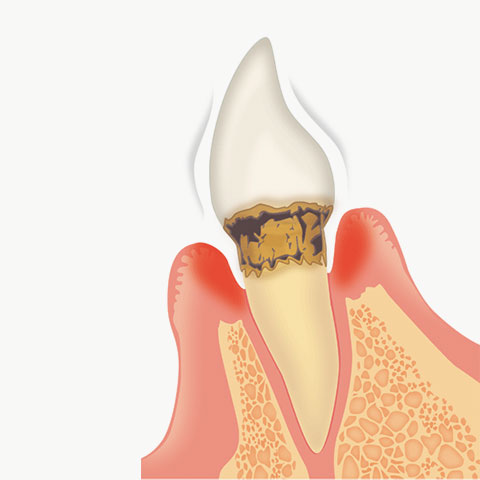 中度歯周炎