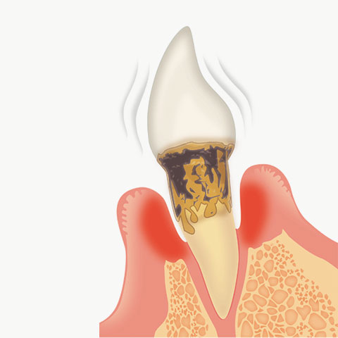 重度歯周炎