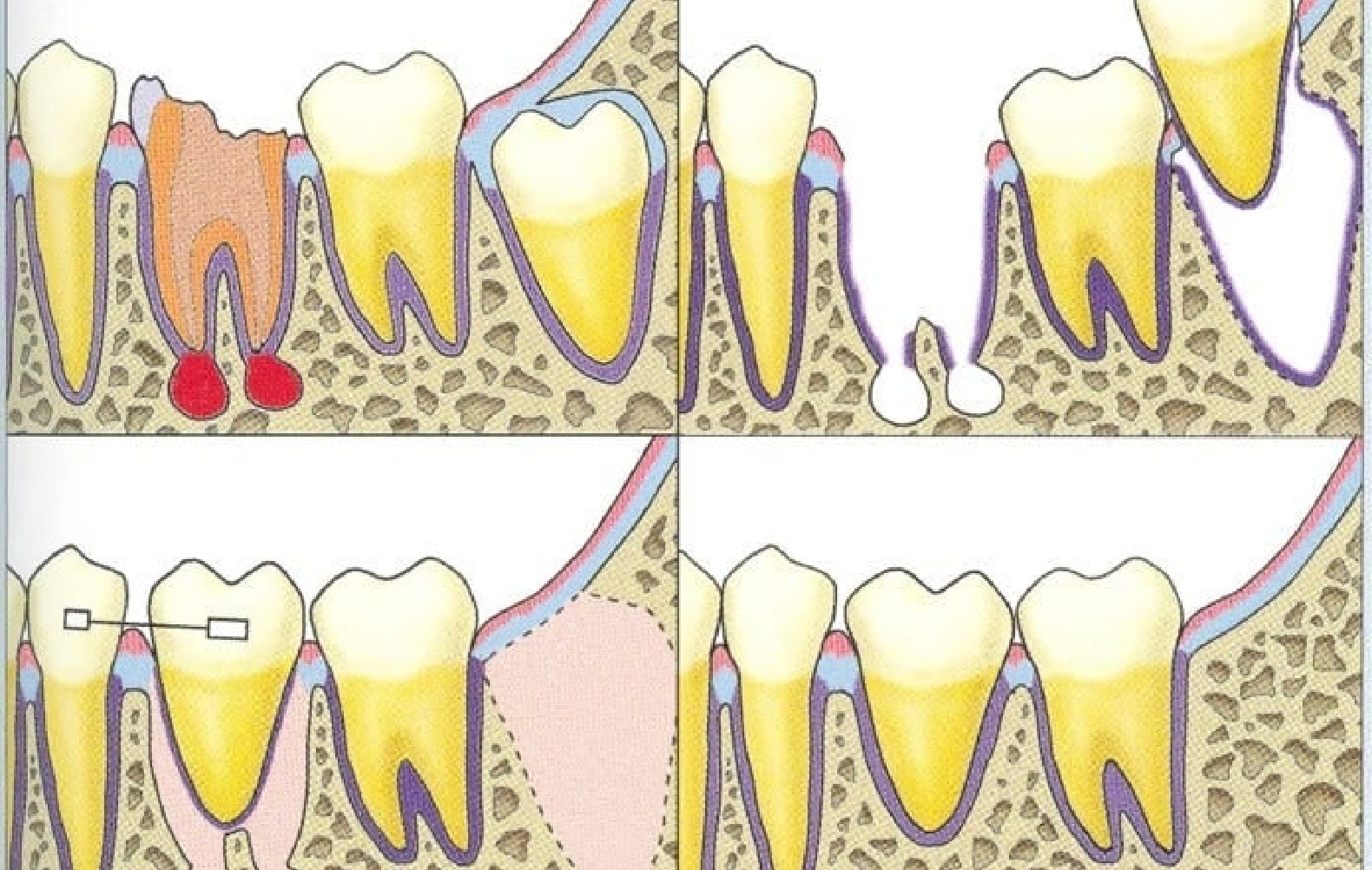 GBR(骨再生誘導法)